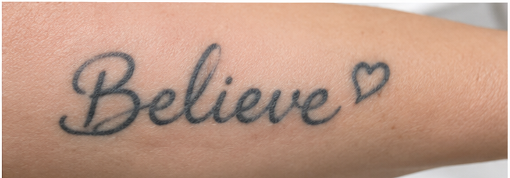 Voor de behandeling — Voor en na: zwarte letter-tatoeage "Believe" op de onderarm verwijderd met PICO-laser
