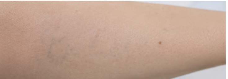 Na de behandeling — Voor en na: zwarte letter-tatoeage "Believe" op de onderarm verwijderd met PICO-laser