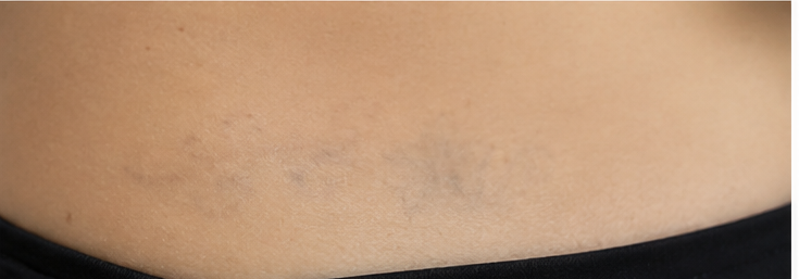 Na de behandeling — Voor en na: bloemrank-tatoeage op de heup verwijderd met PICO-laser