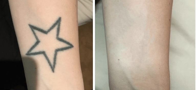 Voor en na: sterretje-tatoeage op de onderarm verwijderd met PICO-laser