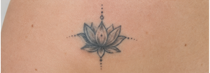 Voor de behandeling — Voor en na: lotus-tatoeage op de onderrug verwijderd met PICO-laser