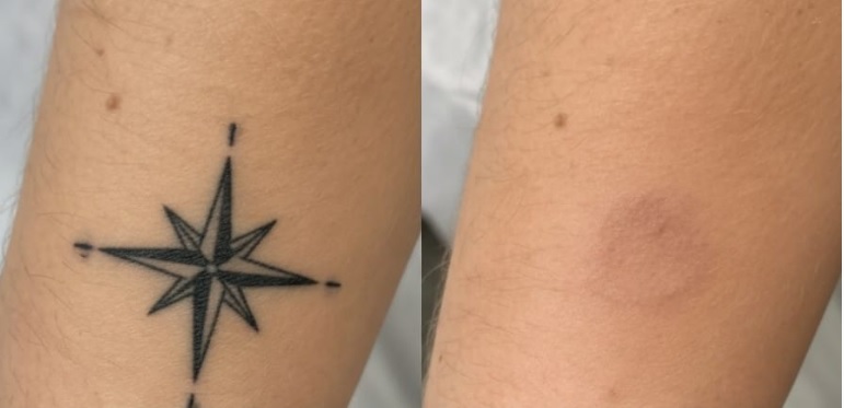 Voor en na: zwarte kompasroos-tatoeage op de onderarm verwijderd met PICO-laser