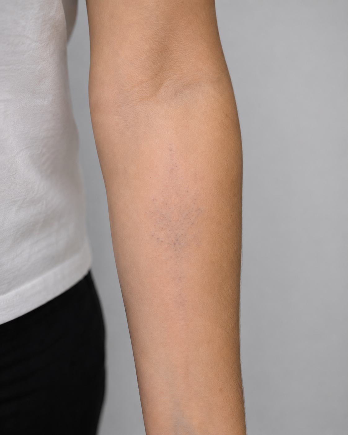 Na de behandeling — Voor en na: fijnlijnige lotus-tatoeage op de onderarm verwijderd met PICO-laser