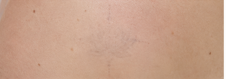 Na de behandeling — Voor en na: lotus-tatoeage op de onderrug verwijderd met PICO-laser