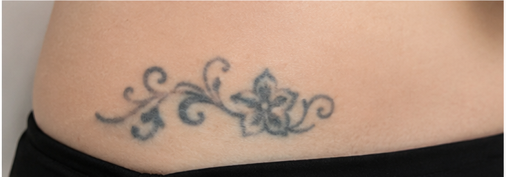 Voor de behandeling — Voor en na: bloemrank-tatoeage op de heup verwijderd met PICO-laser