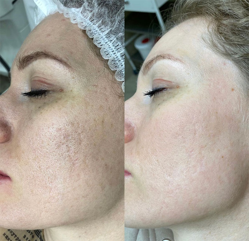Carbon Laser Peeling voor en na resultaat 1