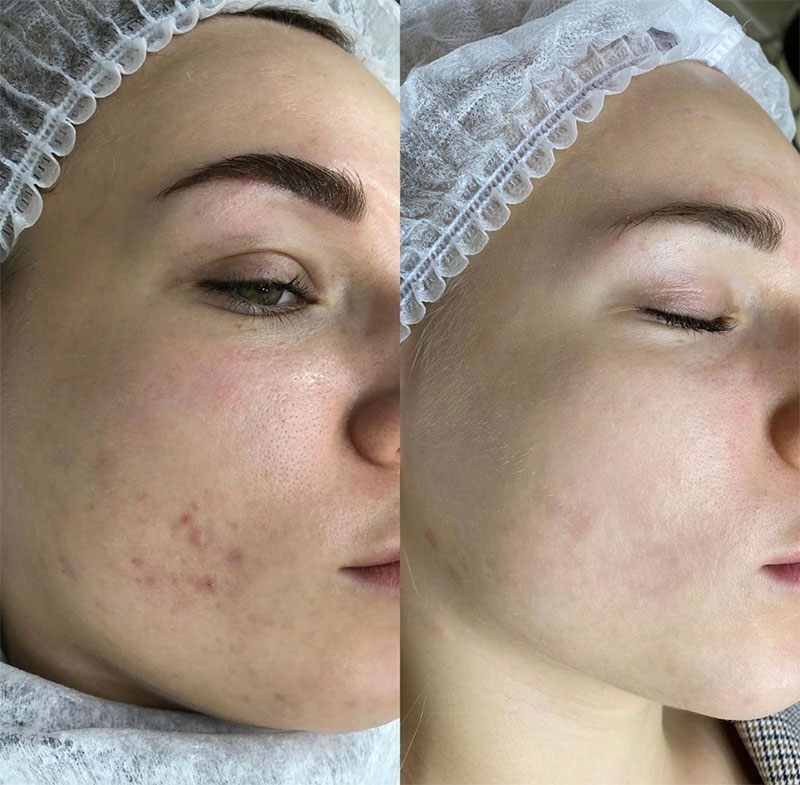 Carbon Laser Peeling voor en na resultaat 2