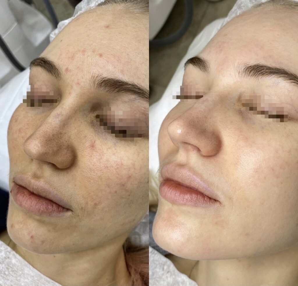 Carbon Laser Peeling voor en na resultaat 3