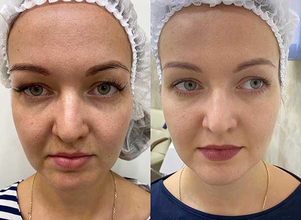 Carbon Laser Peeling voor en na resultaat 4