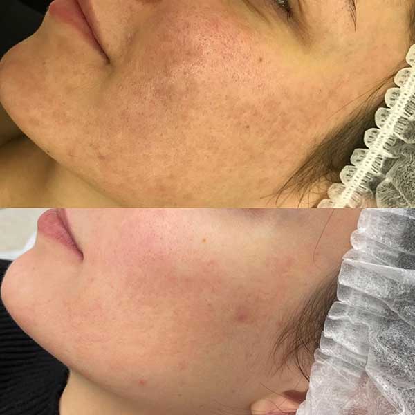 Carbon Laser Peeling voor en na resultaat 5