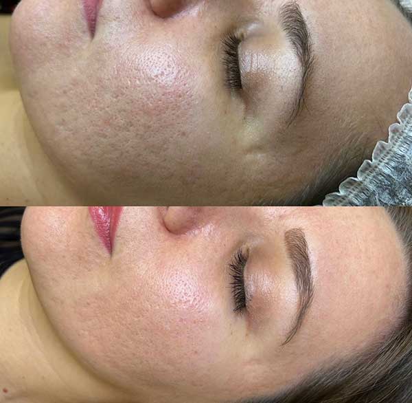 Carbon Laser Peeling voor en na resultaat 6