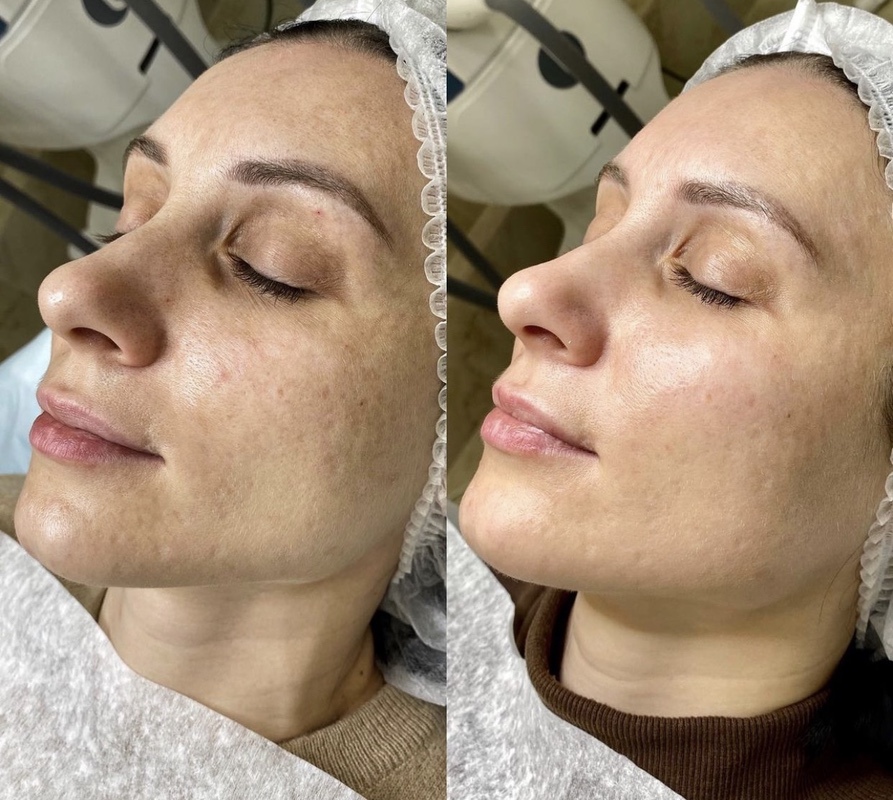 Carbon Laser Peeling voor en na resultaat 7