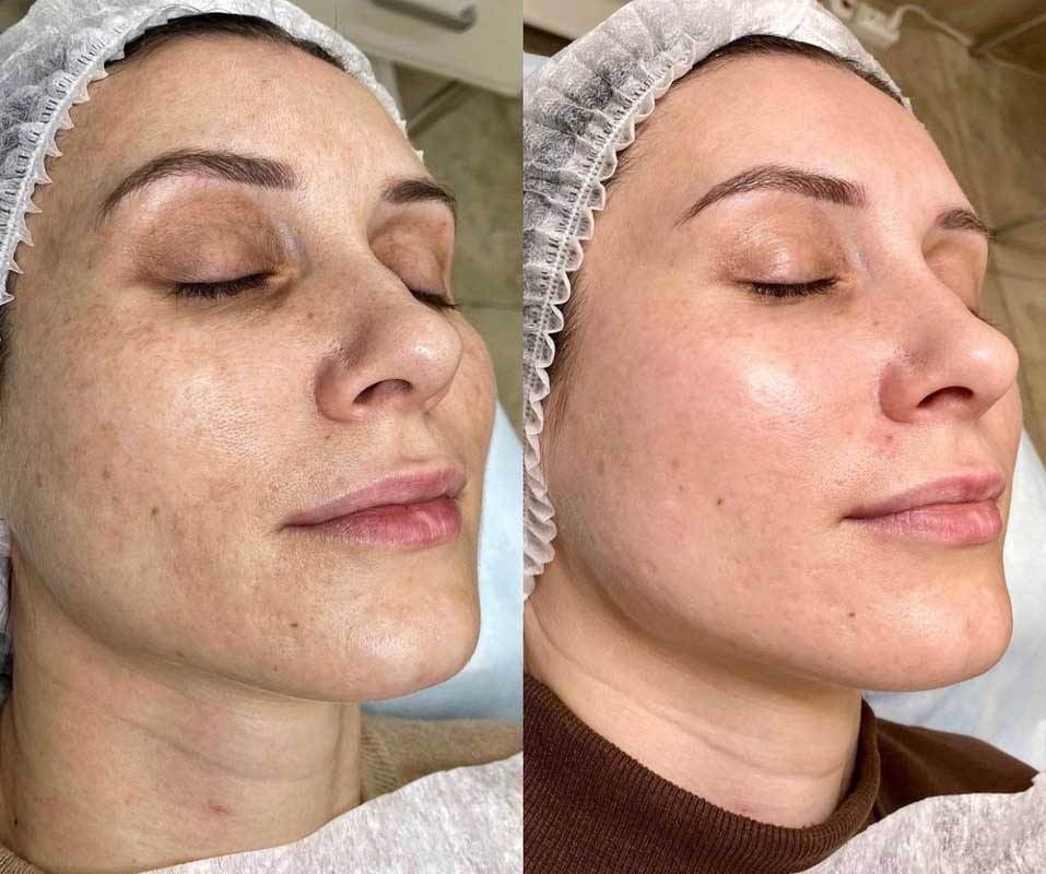 Carbon Laser Peeling voor en na resultaat 8